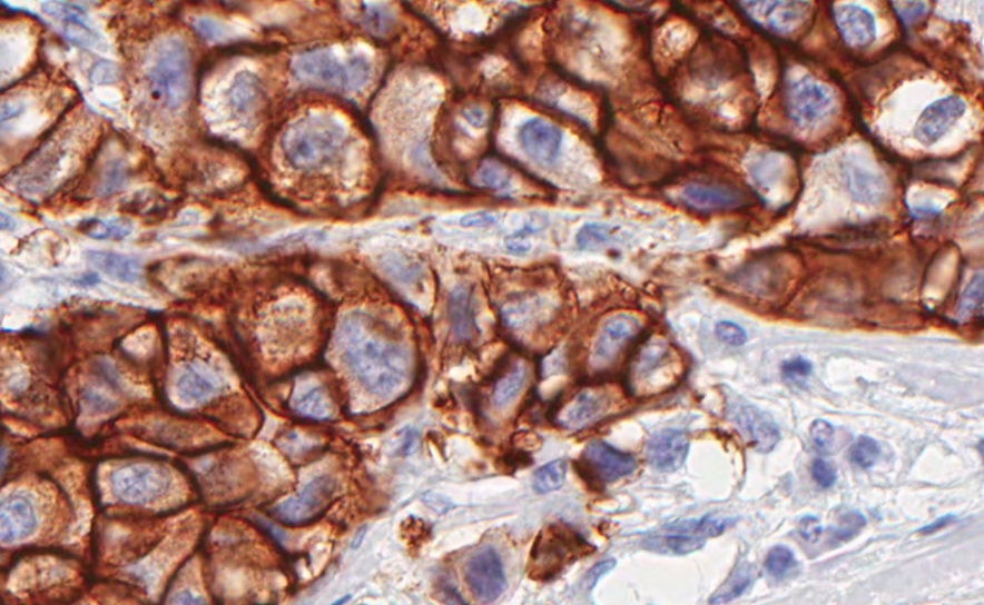 Descoberta proteína que prevê eficácia da quimioterapia em doentes com cancro da mama