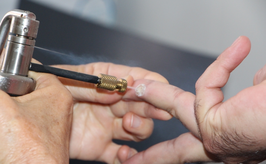 Rastreio gratuito do cancro da pele regressa ao concelho de Alcoutim