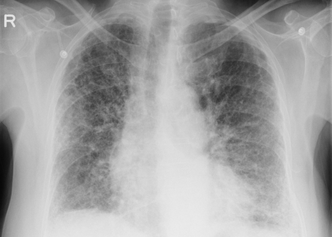 Falta de conhecimento sobre os sintomas da Fibrose Pulmonar compromete o diagnóstico precoce da doença