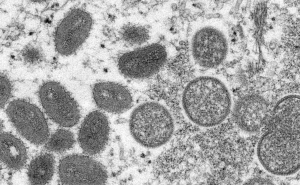 Monkeypox: Mais 16 infeções confirmadas, elevando para 74 o número de casos em Portugal