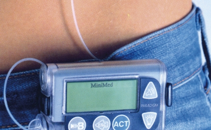 Pessoas com diabetes tipo 2 alcançam melhores resultados com bomba de insulina do que com múltiplas injeções diárias