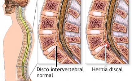 Inovação e segurança no tratamento das hérnias discais 