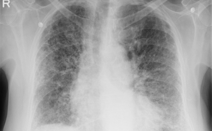 Falta de conhecimento sobre os sintomas da Fibrose Pulmonar compromete o diagnóstico precoce da doença