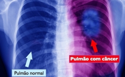 Entidades nacionais reúnem esforços e criam Aliança para o combate ao cancro do pulmão