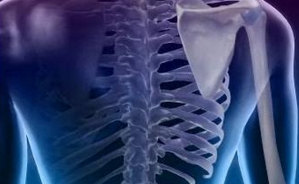 Osteoporose é causa frequente de fraturas na coluna vertebral