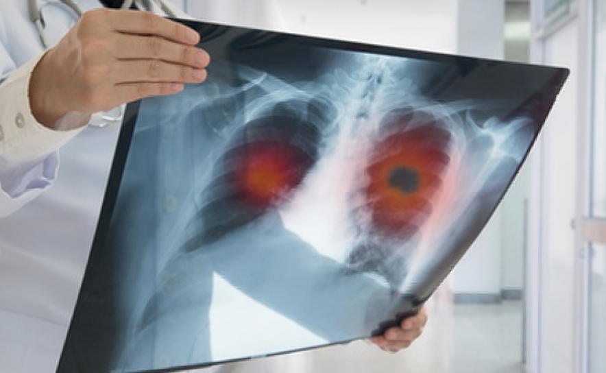 Sociedade de Pneumologia quer via verde para diagnóstico de cancro do pulmão