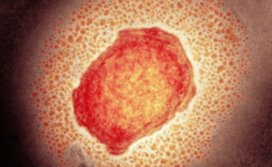 Mais nove casos de infeção pelo vírus Monkeypox confirmados em Portugal, totalizando 14