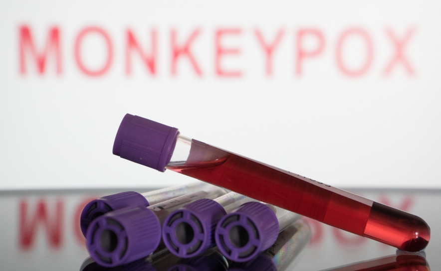 Monkeypox: Número de casos sobe para 365 e já há em todas as regiões do país
