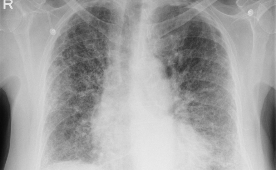 Falta de conhecimento sobre os sintomas da Fibrose Pulmonar compromete o diagnóstico precoce da doença